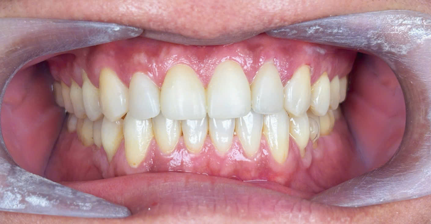 After image